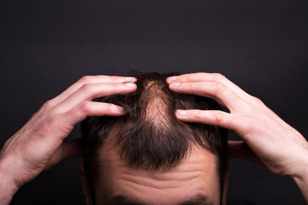 Main Causes of Hair Loss And How To Prevent